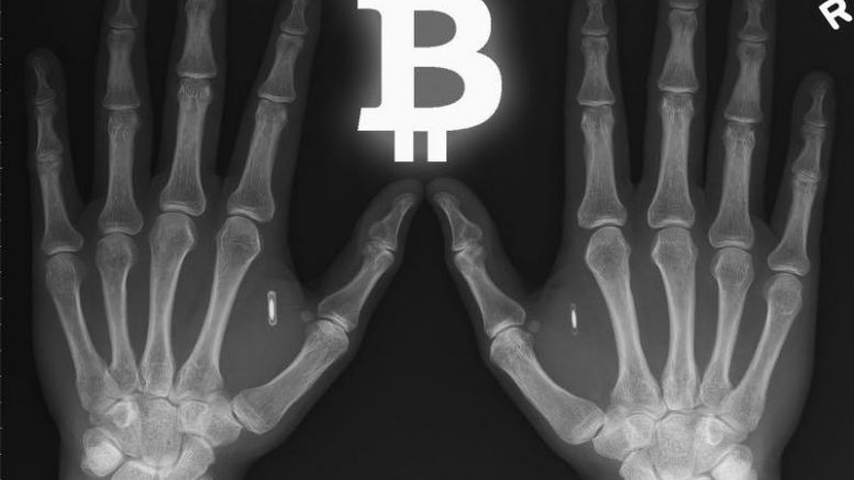 Bio-Implantable Bitcoin Wallets Becoming a Popular Storage Solution