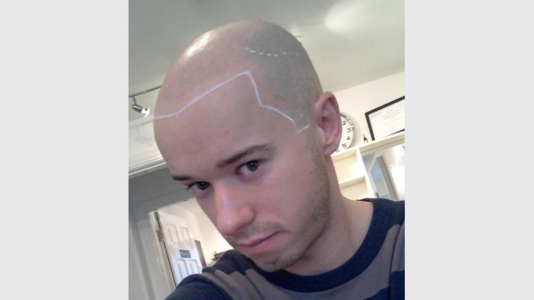London Clinic Performs Hair Transplants For Bitcoin